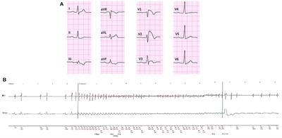 Predictors of late arrhythmic events after generator replacement in Brugada syndrome treated with prophylactic ICD